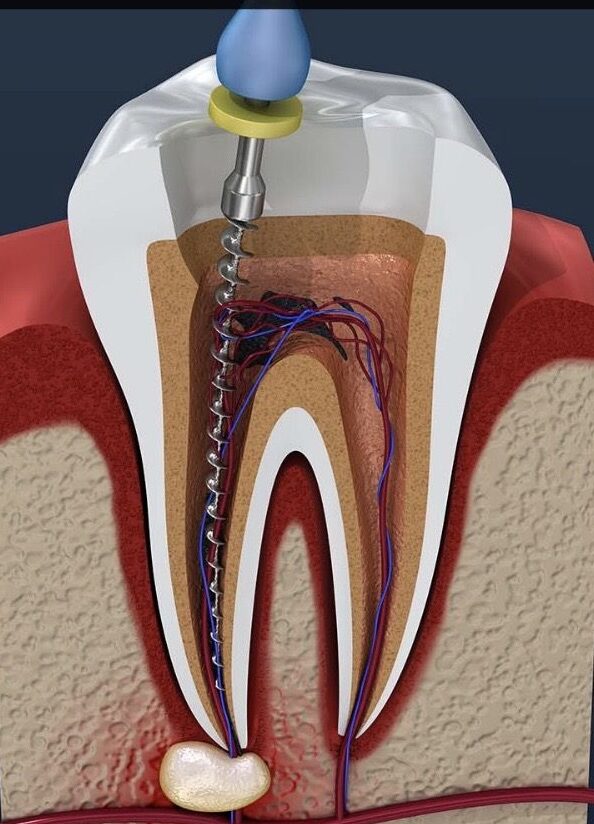 Root Canal Treatment