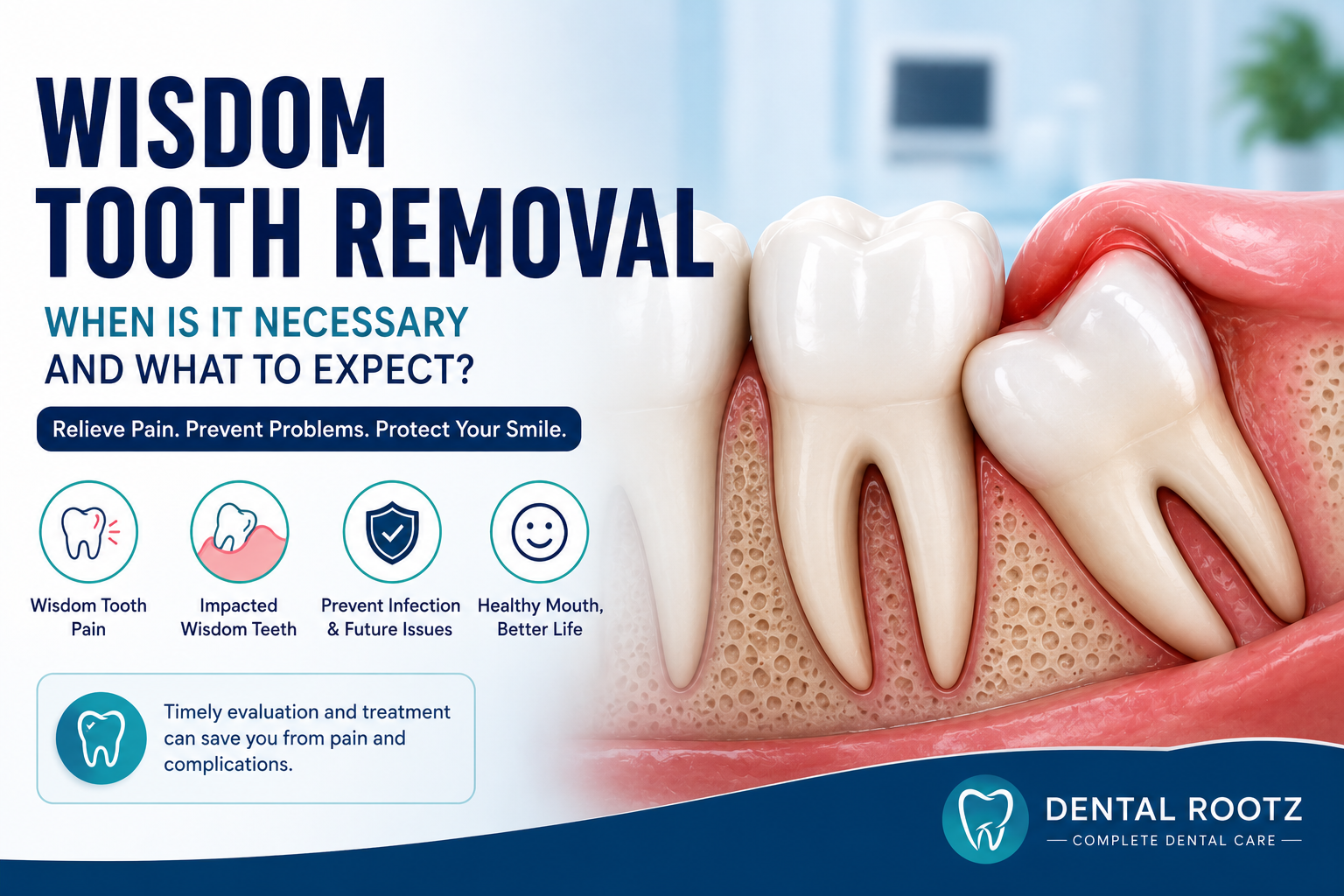 Wisdom Tooth Removal: When Is It Necessary and What to Expect?